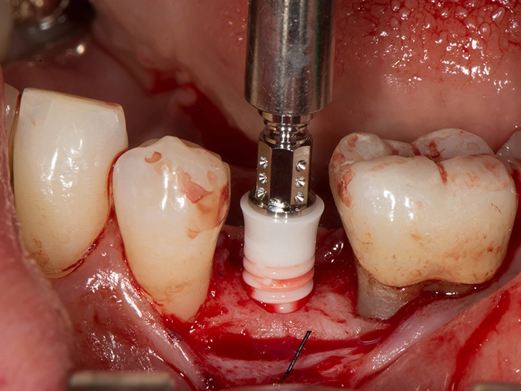 Abb. 3: Intraoperativer Situs während der Eingliederung eines zweiteiligen Keramikimplantates mit Transferteil.