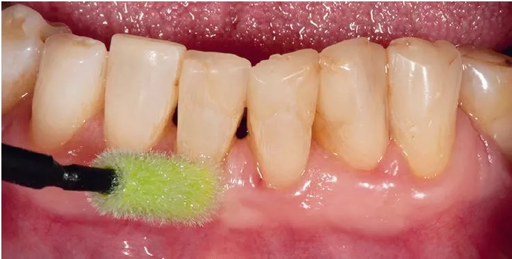 Abb. 3: Zum Abschluss der professionellen Zahnreinigung wird ein Schutzlack mit Chlorhexidin entlang des Gingivalsaumes appliziert.