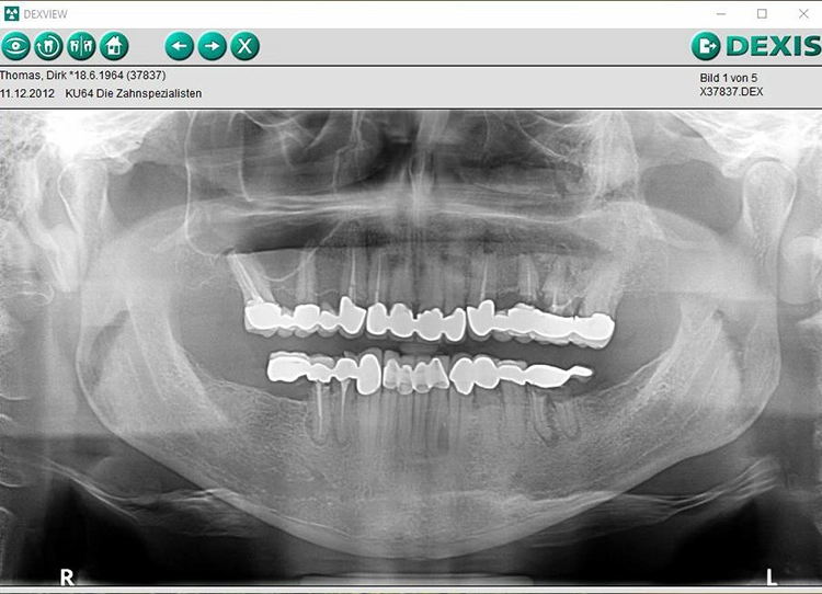 Abb. 3: Röntgenologische Ausgangssituation mit kariösen und endodontischen Läsionen und in der Oberkieferfront mit Zahnschmelz unter den Kronenrändern.