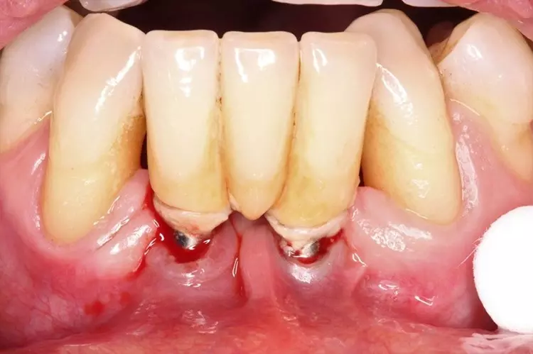 Abb. 3a: Ausgangsbefund Regio 32 bis 42 mit
Implantaten seit vielen Jahren in Funktion.
