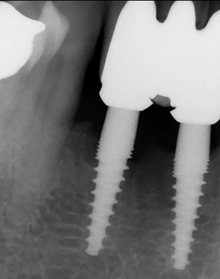 Abb. 3d: Vergleich des Röntgenbefundes prä- vs. 2 Jahre postoperativ.