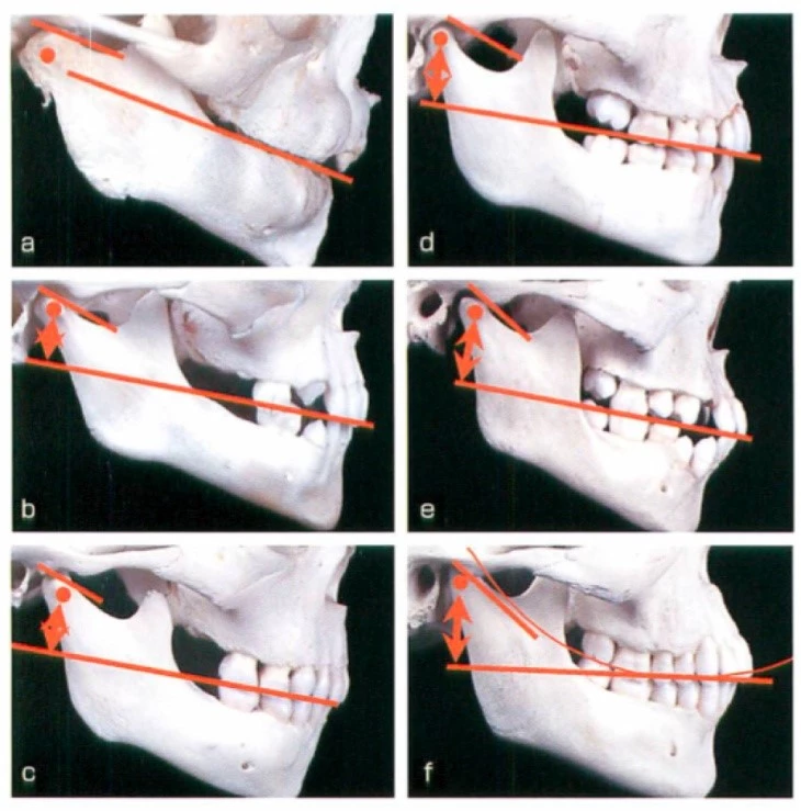 Abb. 3c: Physiologische okklusale und skelettale Entwicklung des menschlichen Untergesichts: a) Neugeborenes, b) frühes Milchgebiss, c) reifes Milchgebiss, d) frühes Wechselgebiss, e) spätes Wechselgebiss und f) reife permanente Dentition.