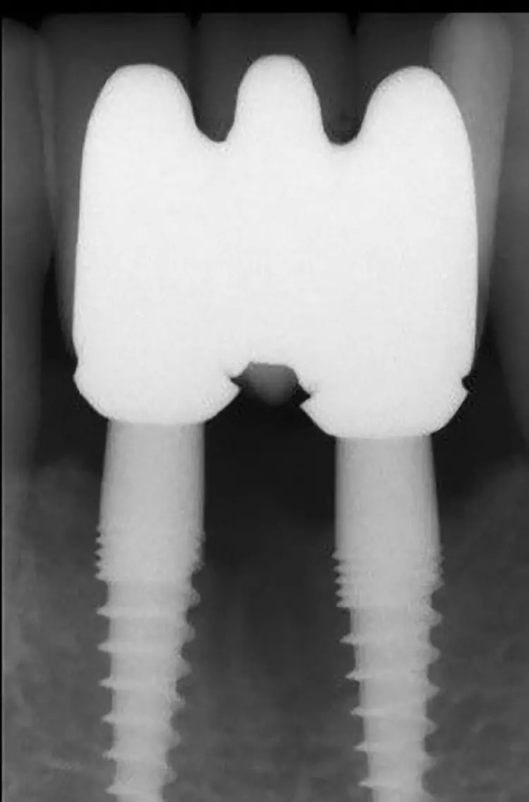 Abb. 3d: Vergleich des Röntgenbefundes prä- vs. 2 Jahre postoperativ.