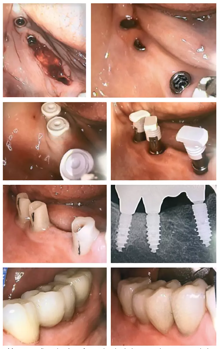 Abb. 4-11: Selbst schmale Kiefer werden durch die MIMI II (GOZ Pos. 9130) ohne Lappenbildungen in der Chirurgie, ohne Wiedereröffnungen in der prothetischen Phase und transgingivalen Abformungen (über den Shuttle des (R)Evolution Implantatsystems durchgeführt.