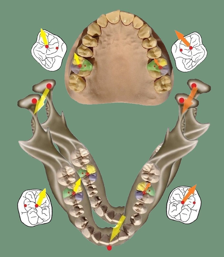 Abb. 4: Latero-Protrusion (gelb) rechts, Medio-Protrusion (orange) links.