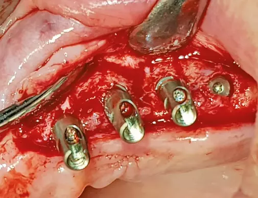 Abb. 4a: Geringe knöcherne Begrenzung der Implantate 23-25 vestibulär.