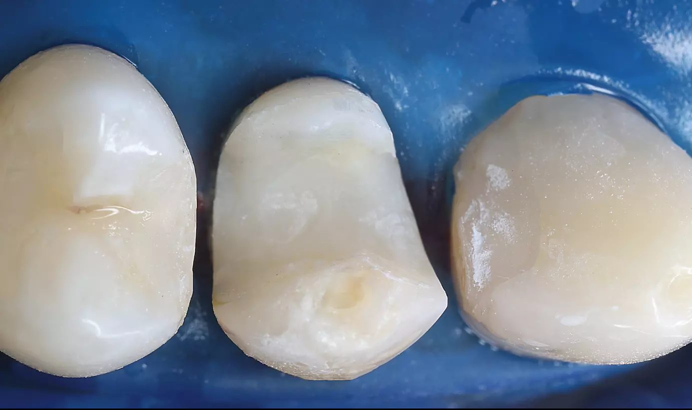 Fertige Präparation für die Versorgung mit einem Cerec-Onlay.