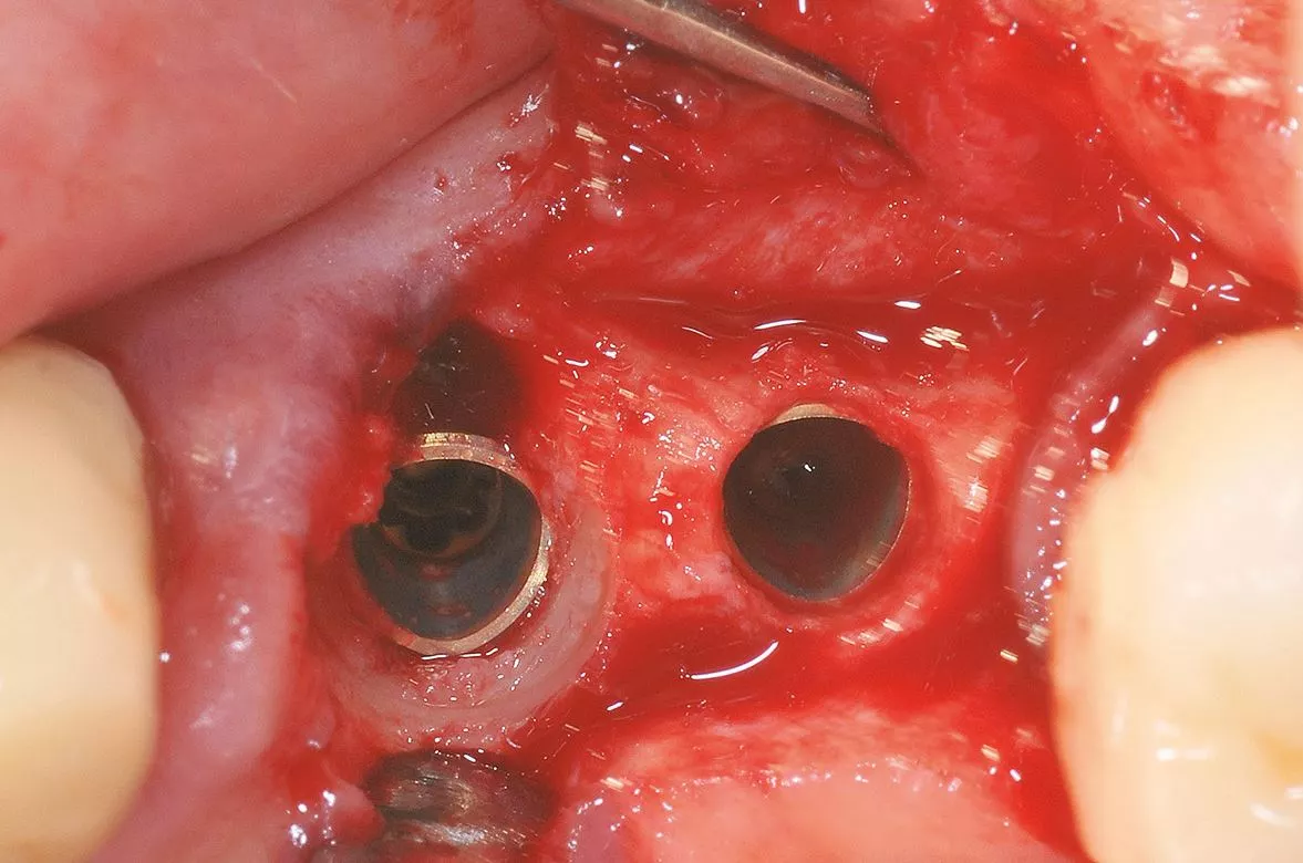 Abb. 4: Implantatinsertion.
