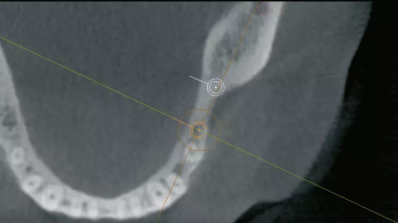 Abb. 4: Bestimmung der Implantatpositionen in der Implantatplanungssoftware Simplant.