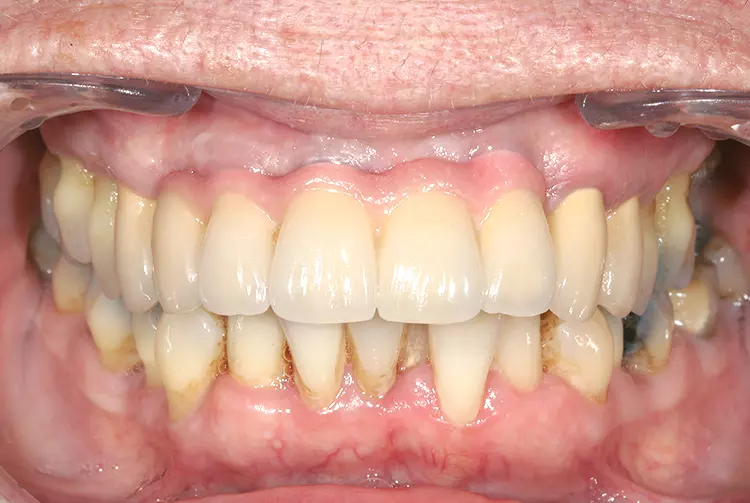Abb. 4: Finale implantatgetragene Versorgung mit vollkeramischen verblockten Kronen (Christian Thie Dentaldesign).