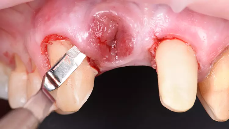 Abb. 4: Präparation eines Tunnels zur Aufnahme eines Tubertransplantates.