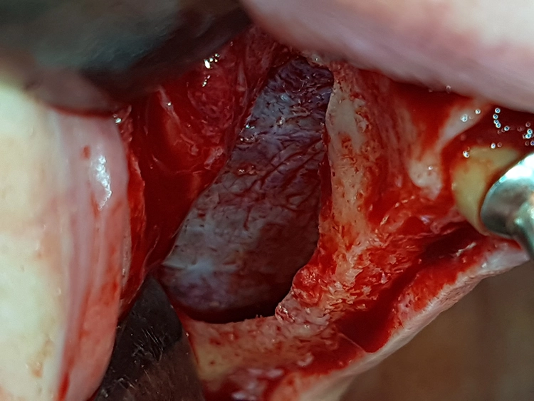 Abb. 4: Darstellung der Schneider’schen Membran nach bukkaler Eröffnung mit Piezosurgery in regio 17-15.