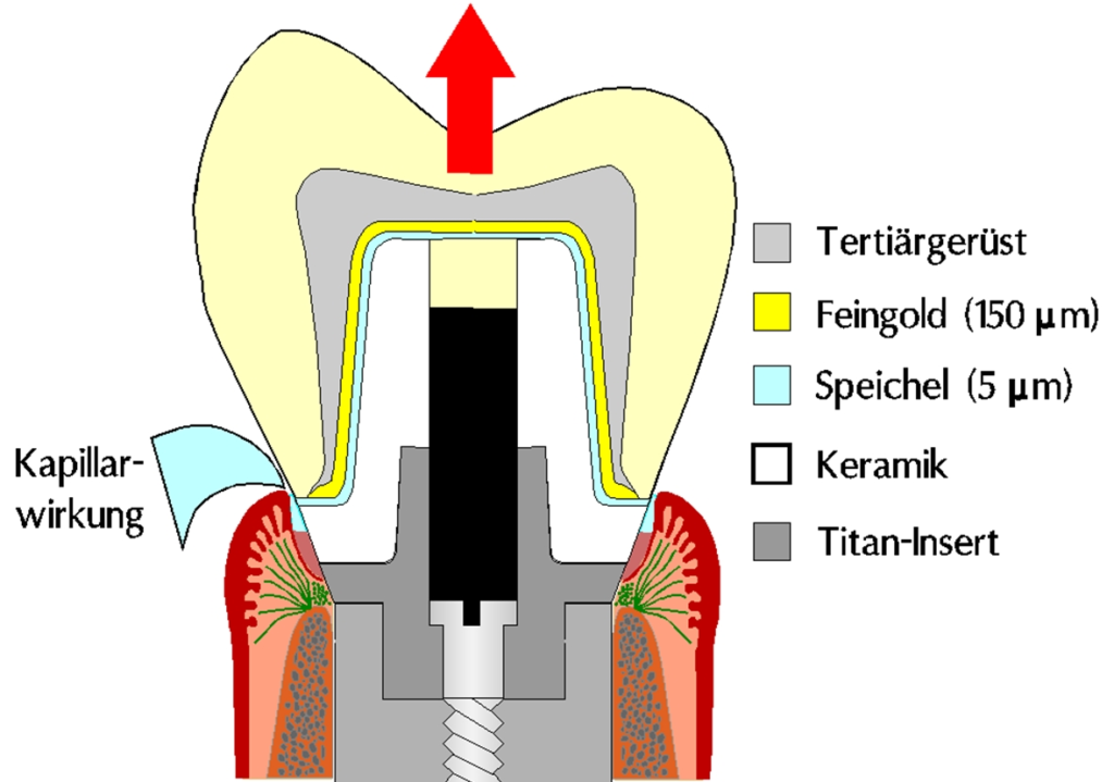 Abb. 4: Schematische Darstellung einer Galvanodoppelkrone, zur adhäsiven Haftkraft kommen noch die nötigen Abzugskräfte durch Nachfließen von Speichel in den Kapillarspalt (Saugwirkung).