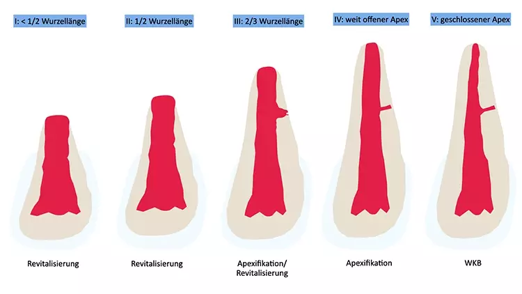 Abb. 4: Schematische Darstellung der verschiedenen Stadien der Wurzelentwicklung
nach Cvek mit entsprechender Therapieempfehlung.