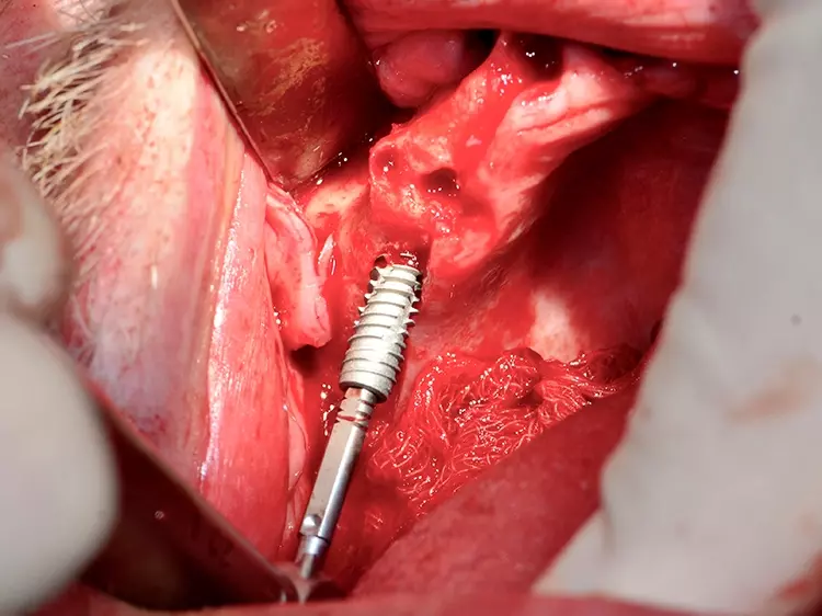 Abb.4: Implantatinsertion eines angulierten Axiom® X3-Implantates in die Extraktionsalveole
im Oberkiefer.