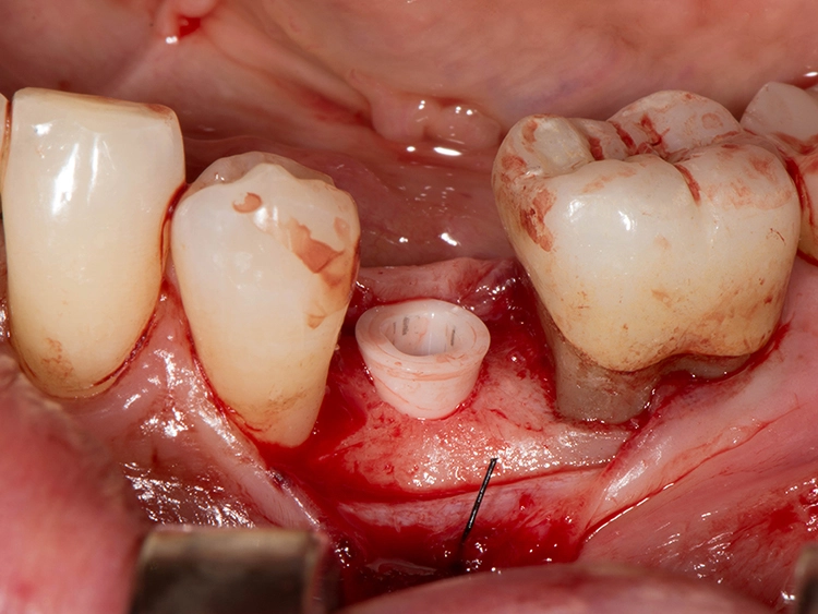 Abb. 4: Intraoperativer Situs, eingesetztes Keramikimplantat.