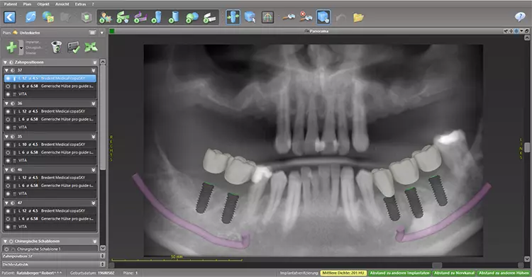 Abb. 4: Ausgangssituation und Planung der Implantatpositionen.