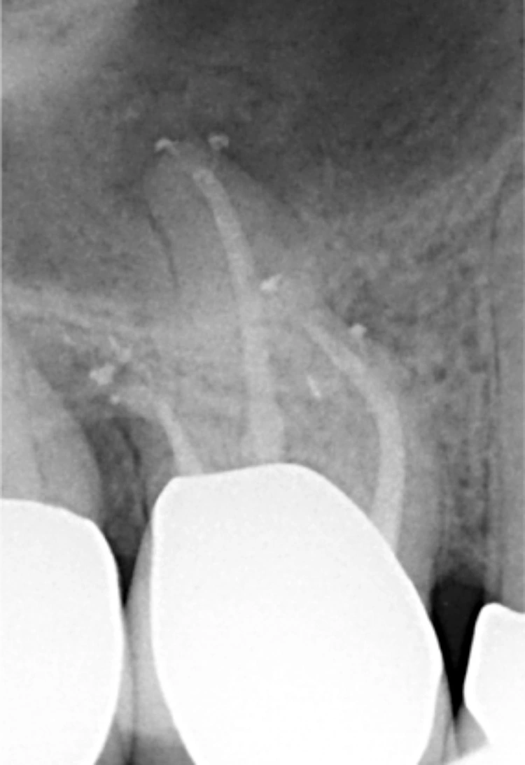 Abb. 4: OK-Molar post op.