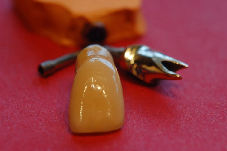 Abb. 4: Individuelles Abutment aus einer hochgoldhaltigen Legierung – bei heutigem Wertverlust des Geldes kaum noch vorstellbar.