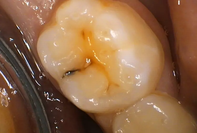 Abb. 4: Kleinste okklusale Veränderungen können auf eine beginnende Dentinkaries hindeuten und müssen bereits in diesem Stadium minimalinvasiv versorgt werden.