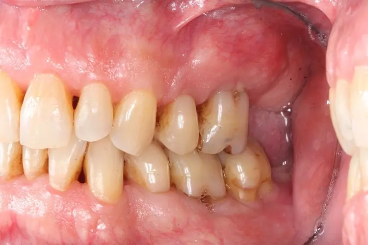 Abb. 4a-c: Klinische Bilder eines 60-jährigen Patienten mit einer generalisierten Parodontitis Stadium 3 Grad B. Der Patient nimmt seit 5 Jahren an der regelmäßigen UPT
teil. Im Rahmen der systematischen Parodontitistherapie erfolgten nach der subgingivalen Instrumentierung mehrere parodontalchirurgische Eingriffe mit dem Ziel, die
Furkationsbereiche der Ober- und Unterkiefermolaren der täglichen Mundhygiene mit Interdentalraumbürstchen zugänglich zu machen. Hier findet sich eine Indikation
für die Anwendung von Pulver-Wasserstrahl-Gemischen, da der anatomisch differenzierte Furkationsbereich für traditionelle Verfahren der Instrumentierung schwierig
und oft nur unzureichend zu erreichen ist.