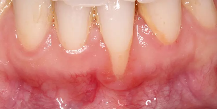 Abb. 4a: Ausgangssituation des Rezessionstyps 1,
Ansicht von vestibulär.