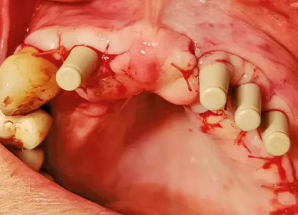 Abb. 4c: Nahtverschluss, Standardabutments und Basiskappen, die in das stuhlgefertigte Provisorium (Tiefziehschiene nach Set-up, ProTemp®) integriert werden.