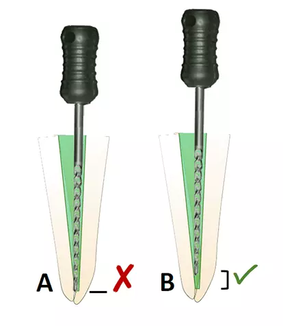 Abb. 5: Prinzip des Apical Gaugings. Beispielhaft wird mit einer ISO 40 NiTi-Feile überprüft, ob die erfolgte Aufbereitung bis ISO 35 ausreichend ist.
a) Die Feile gleitet bis zur festgelegten Arbeitslänge; die Aufbereitung reicht nicht aus – es muss eine weitere Präparation erfolgen.
b) Die Feile klemmt vor der definierten Arbeitslänge; die Aufbereitung ist suffizient und die Obturation kann erfolgen.