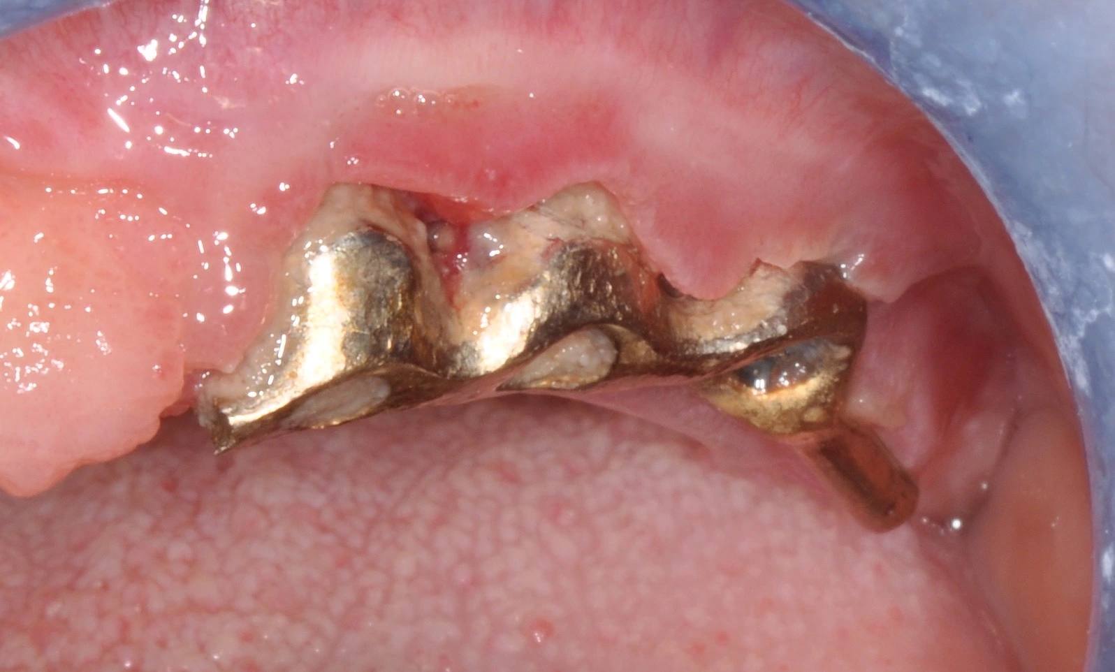 Abb. 5: Implantatsteg mit umfangreichen Plaqueablagerungen und manifester Mukositis.