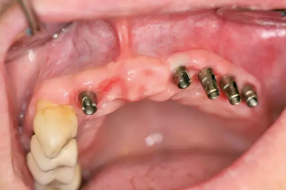 Abb. 5a: Stabiles periimplantäres Weichgewebe nach 8 Wochen.