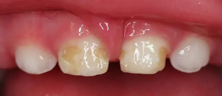 Abb. 5: Gingivitis und Karies bei einem 12 Monate alten Kind sind frühe Zeichen
von ECC. Die kariösen Läsionen sind meist erst nach Plaqueentfernung zu
detektieren.