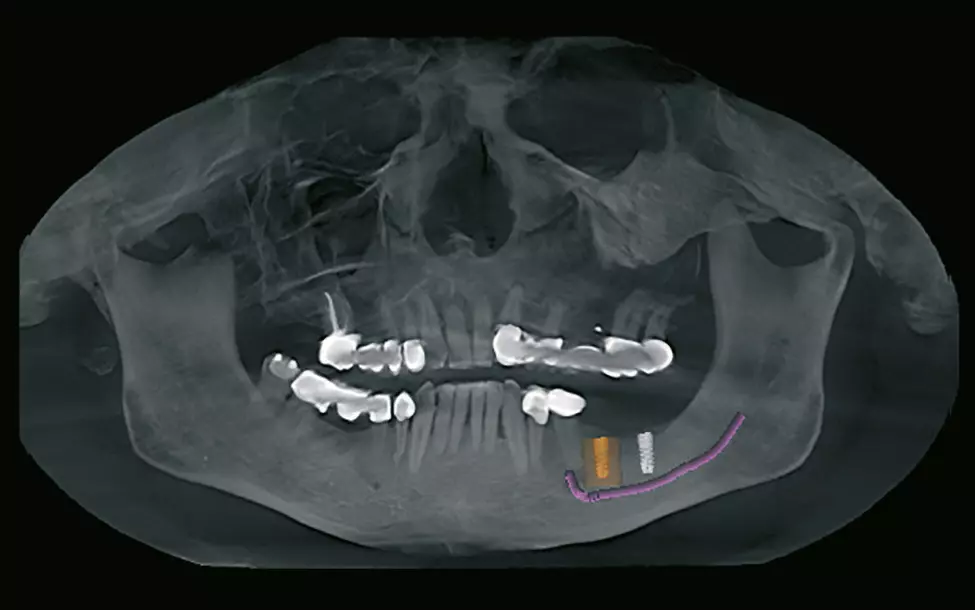 Abb. 5: Anatomisch und prothetisch orientiert geplante Implantate in regio 36/37.