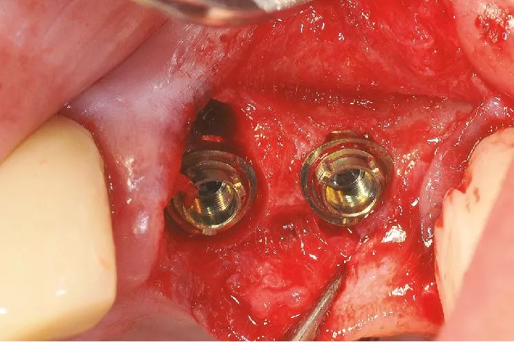 Abb. 5: Versorgung mit Nobel Biocare N1™ Base Xeal™ Xeal TCC RP 1,75 mm.