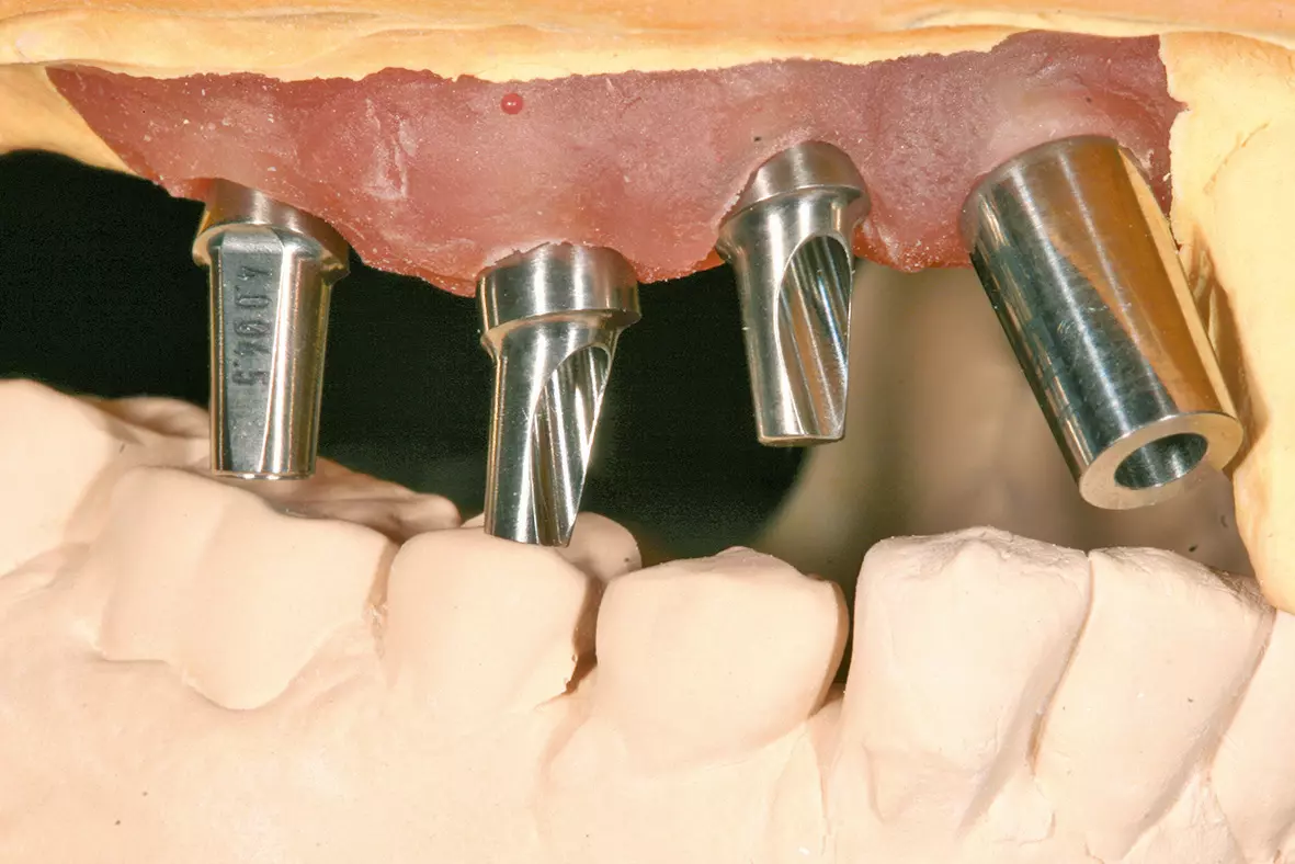 Abb. 5: Modifizieren der Aufbauten im Dentallabor entsprechend den klinischen Vorgaben.
