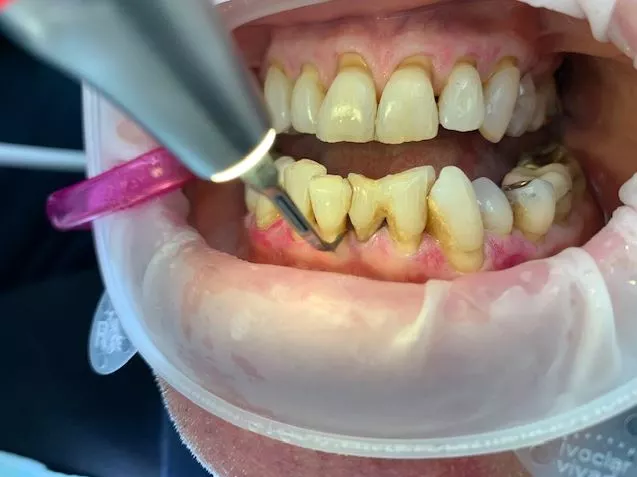 Abb. 5: Piezon-PS-Anwendung.