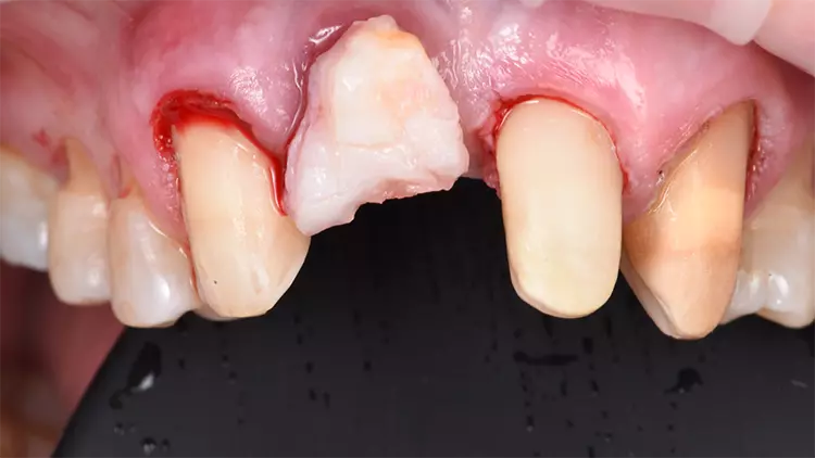Abb. 5: Tubertransplantat.