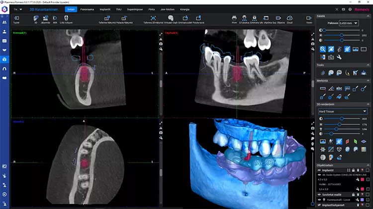 Abb. 5: Die Implantatplanung erfolgte in Planmeca Romexis®.