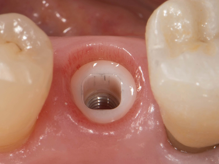 Abb. 5: Klinische Situation drei Monate nach Implantation. Reizlose periimplantäre Schleimhautverhältnisse.