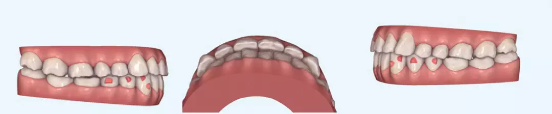 Abb. 5: Ausgangssituation: Der ClinCheck Invisalign® zeigt den stark reduzierten horizontale Überbiss.