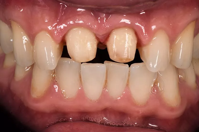 Abb. 5a und 5b: Klinischer Fall mit Präparation (links) und Endresultat (rechts). Beide Zähne wurden mit Kronen aus CEREC Tessera, mittlere Transluzenz, Farbe A2, versorgt. Dank eines ausgezeichneten Chamäleon-Effekts lässt das ästhetische Resultat nichts zu wünschen übrig.