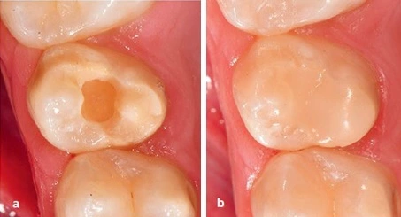Abb. 5a u. b: Minimalinvasive Versorgung eines okklusalen Schmelzeinbruchs an einem Prämolaren mit einer adhäsiven Restauration.