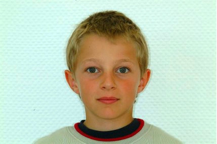 Abb. 5a: En-face-Aufnahmen 9-jähriger Klasse-II-Patient.