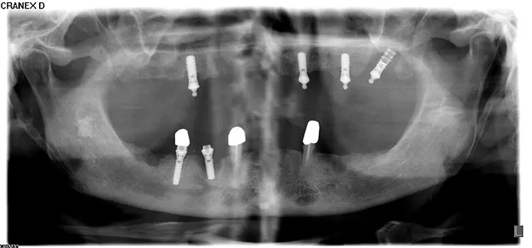 Abb. 5a–d: Radiologisches und klinisches Bild eines 66-jährigen kaukasischen
Patienten aus Griechenland. Es imponieren die ausgeprägten Osteolysen und
mukosalen Entzündungszeichen an zahlreichen Implantaten im Ober- und
Unterkiefer. Die Diagnosen lauten Parodontitis Stadium 4 Grad C und fortgeschrittene
Periimplantitis. Der Patient ist langjähriger Raucher und weist
mehr als 40 Schachteljahre auf.
