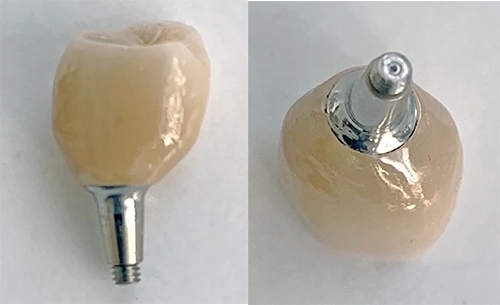 Abb. 5b: Einzelkronen, mit Abutments laborseits zu sogenannten Kronenabutments verklebt.