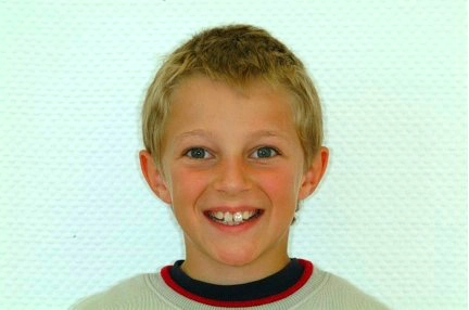 Abb. 5b: En-face-Aufnahmen 9-jähriger Klasse-II-Patient.