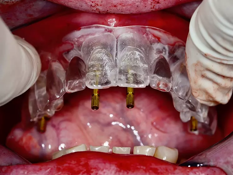 Abb. 5: Überprüfen der korrekten Position der Implantate mit Hilfe einer Schablone,
die die spätere prothetische Versorgung simuliert.