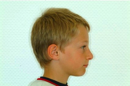 Abb. 5c: Profilaufnahmen 9-jähriger Klasse-II-Patient.