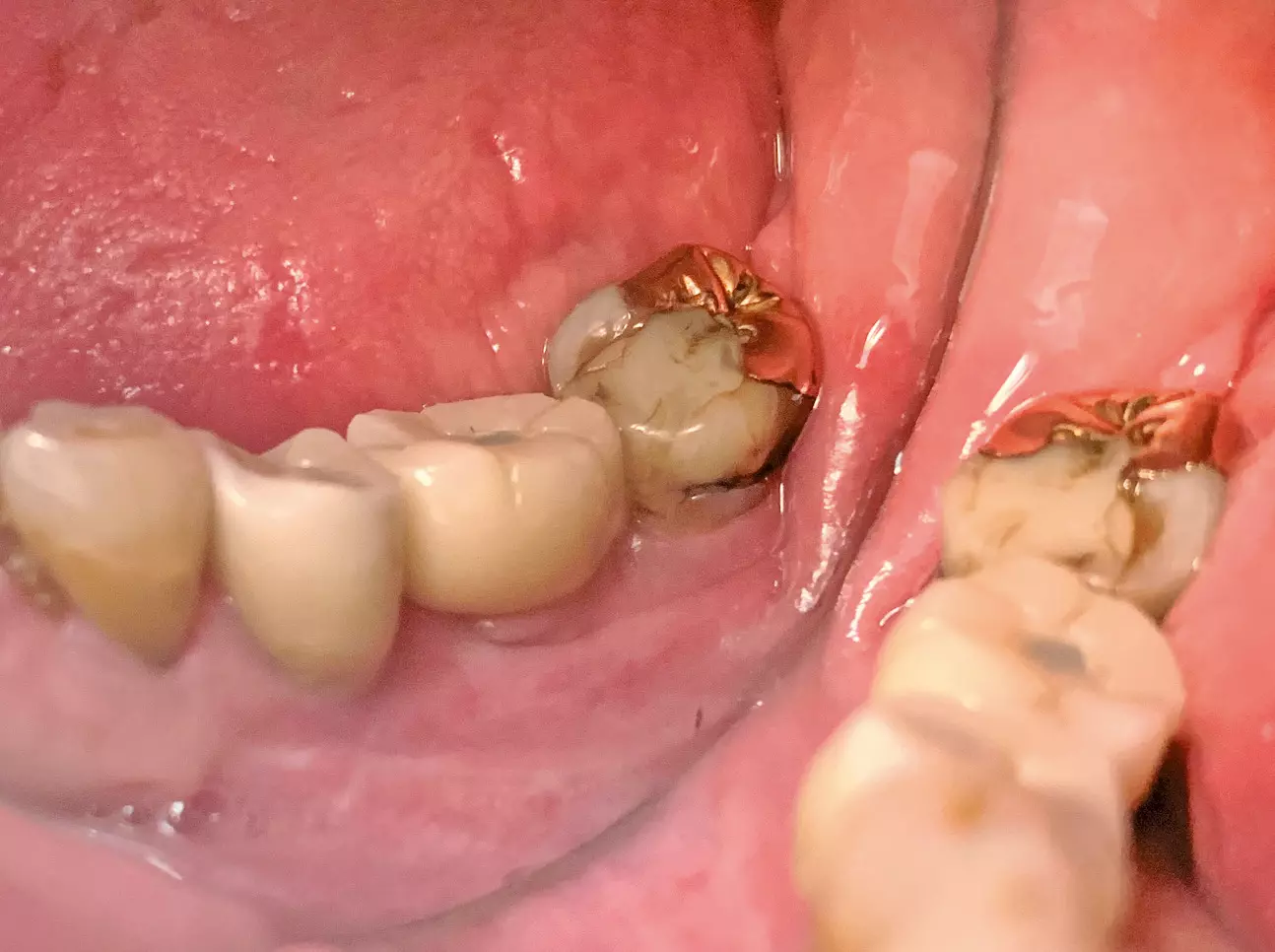 Abb. 5d: In den Implantaten verschraubte Kronenabutments.