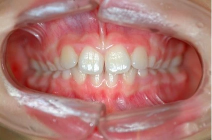 Abb. 5e: Intraorale Fotografien 9-jähriger Klasse-II-Patient (Frontalansicht, Overbite/Overjet, Lateralansicht rechts/links).