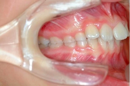 Abb. 5g: Intraorale Fotografien 9-jähriger Klasse-II-Patient (Frontalansicht, Overbite/Overjet, Lateralansicht rechts/links).